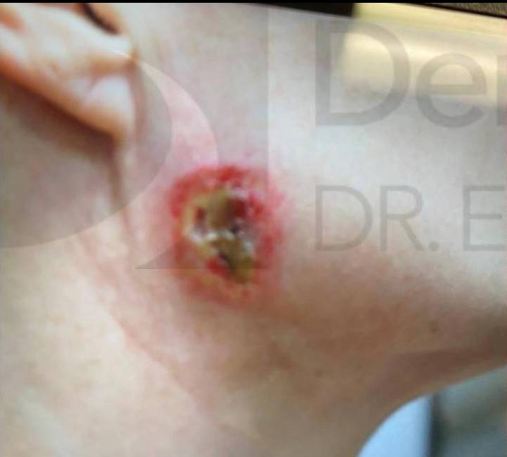 Exosomes Before and After Before