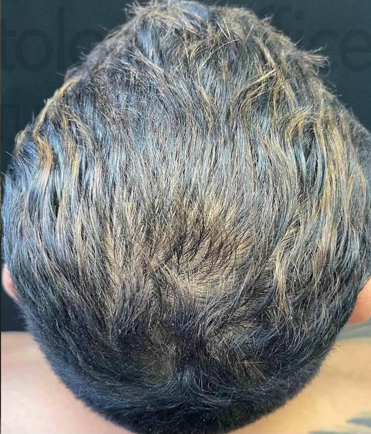 Platelet-Rich Plasma (3 Treatment) Case-4 After