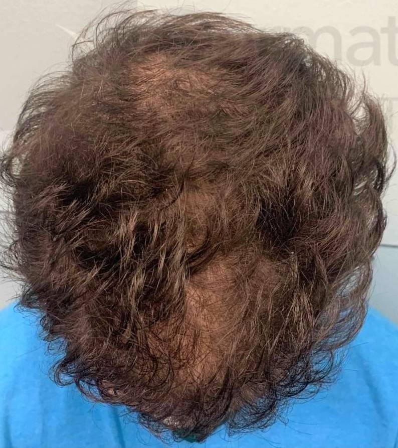Hair Restoration (2 Treatment Exosomes) Case-8 Before