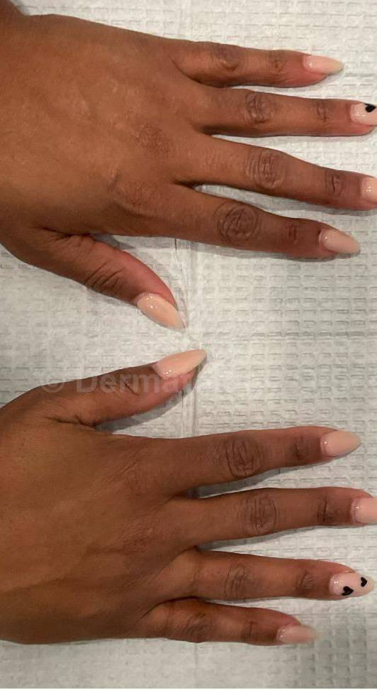 Fillers Before and After Case 3 Before