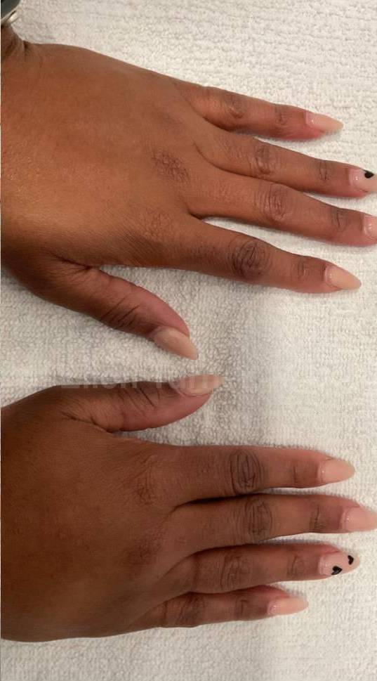 Fillers Before and After Case 3 After