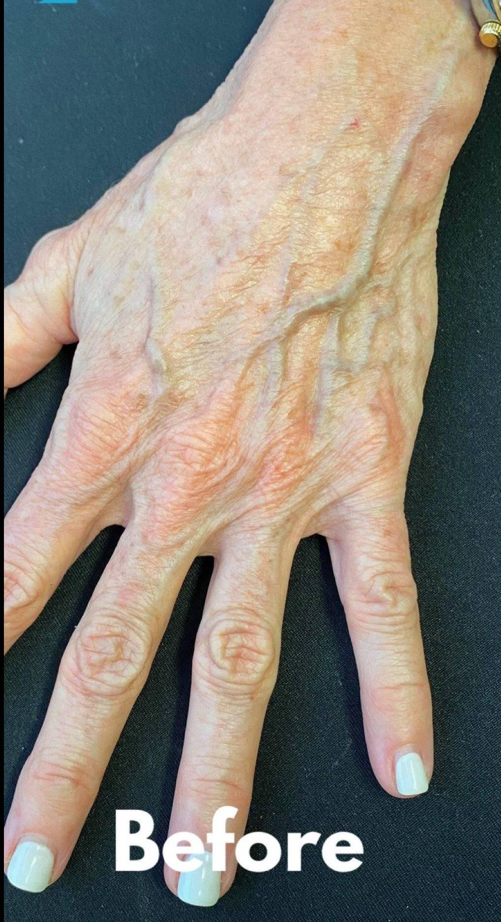 Radiesse Hands (2 Syringes) Before and After Case 8 Before