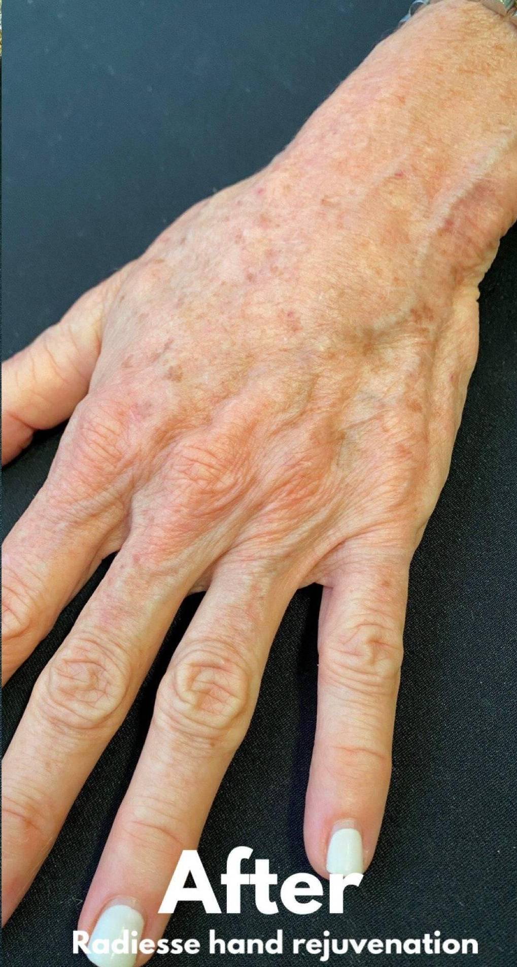 Radiesse Hands (2 Syringes) Before and After Case 8 After