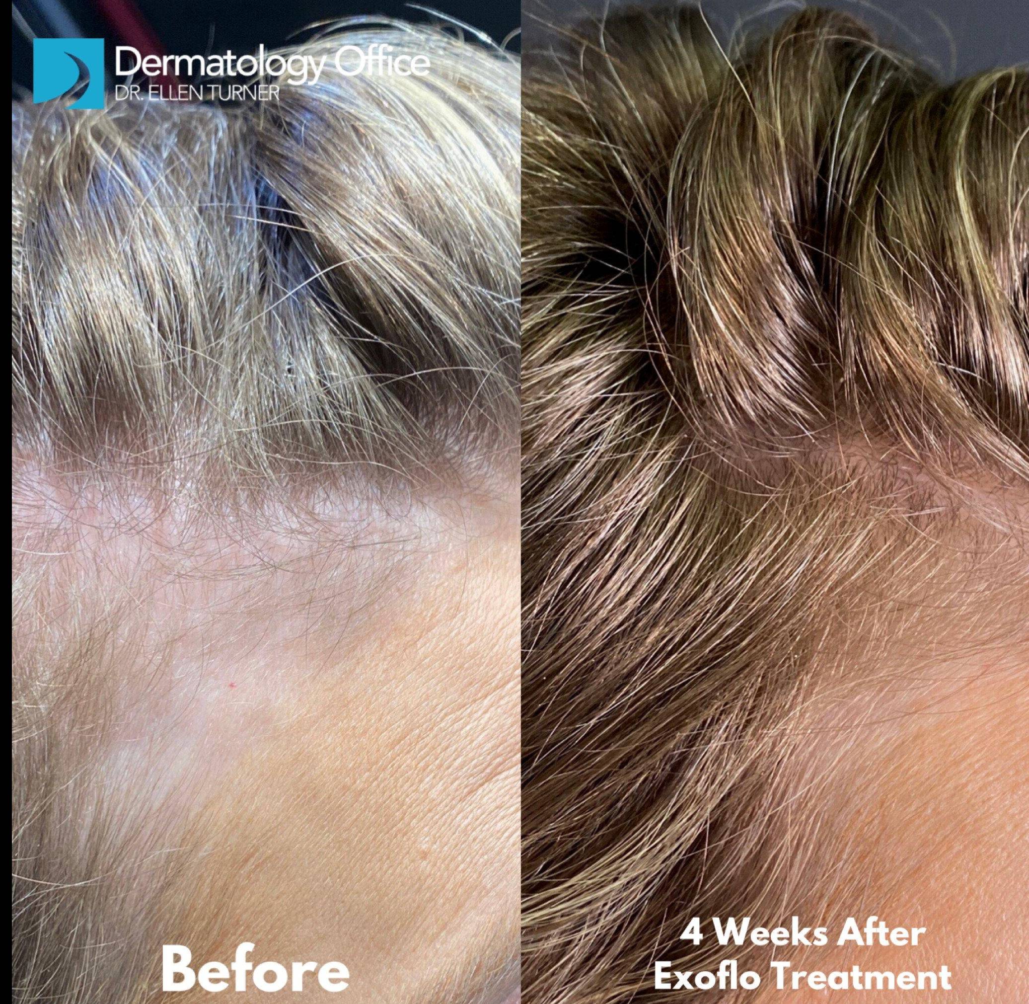 Exoflo-Hair Restoration Before and After Case 1 