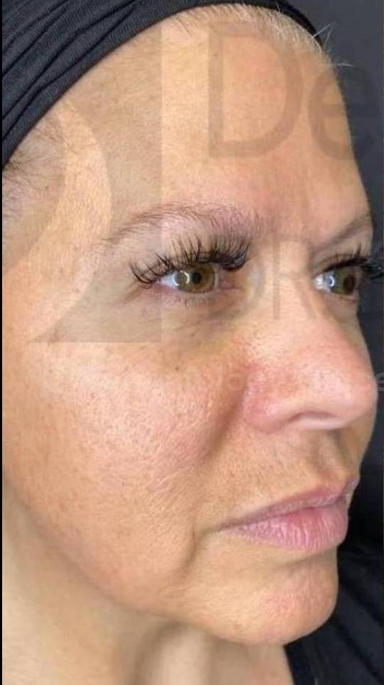 Voluma (13 Syringes) Case 2 Before