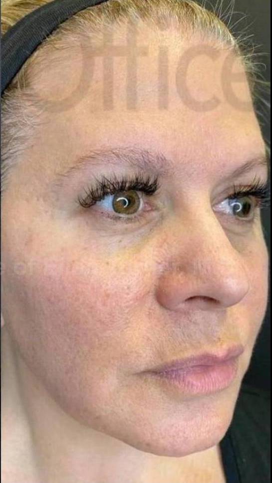 Voluma (13 Syringes) Case 2 After