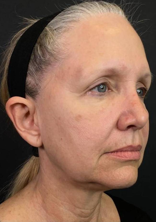 Volbella (1 syringe) Before and After Case 3 Before