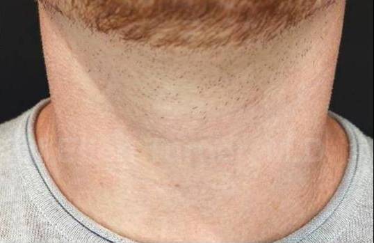 Volbella (2 syringes) Before and After Case 5 After