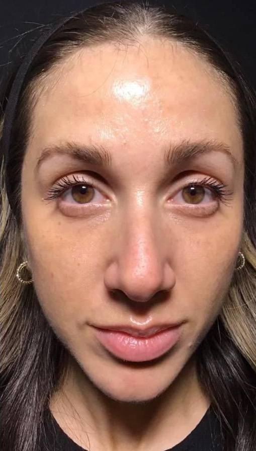 Voluma (5 Syringes) Case-7 Before