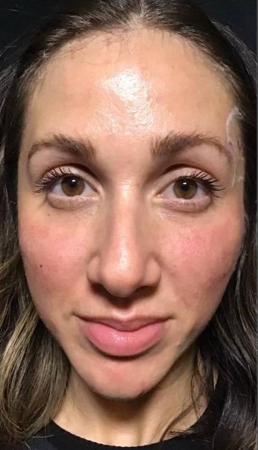 Voluma (5 Syringes) Case-7 After