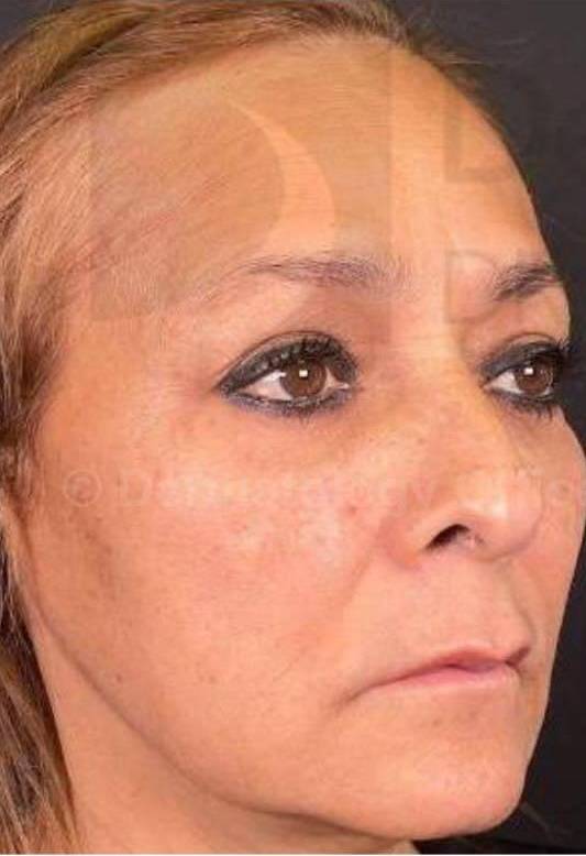 Voluma (3 Syringes) Case-8 Before