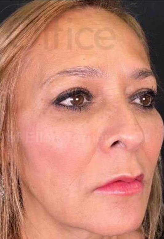 Voluma (3 Syringes) Case-8 After