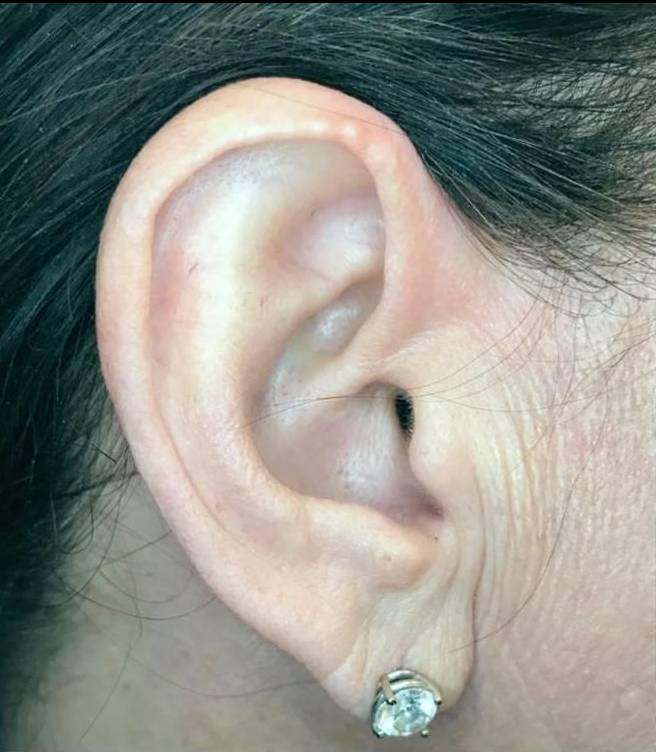 Juvederm (1 Syringe) Case-12 Before