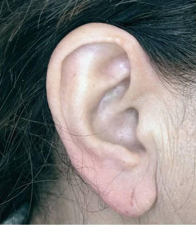 Juvederm (1 Syringe) Case-12 After