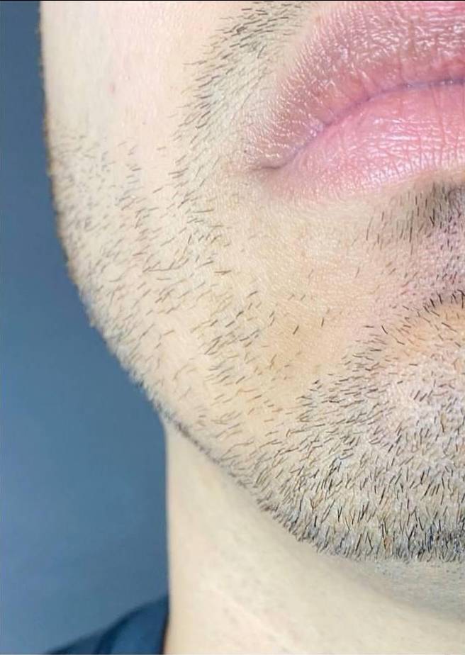 Voluma (4 Syringes) Case-11 Before