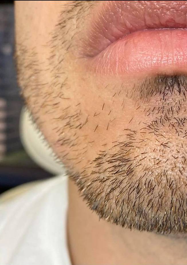 Voluma (4 Syringes) Case-11 After