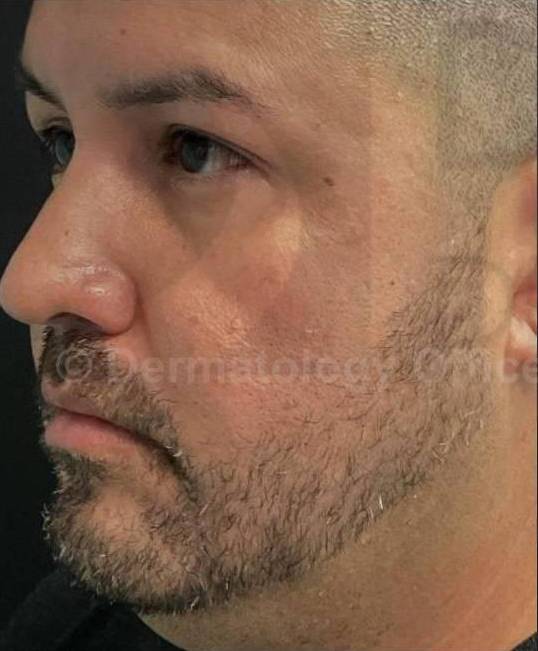 Voluma (4 Syringes) Case-14 Before