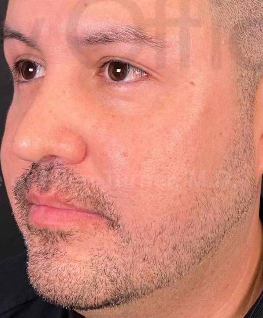 Voluma (4 Syringes) Case-14 After