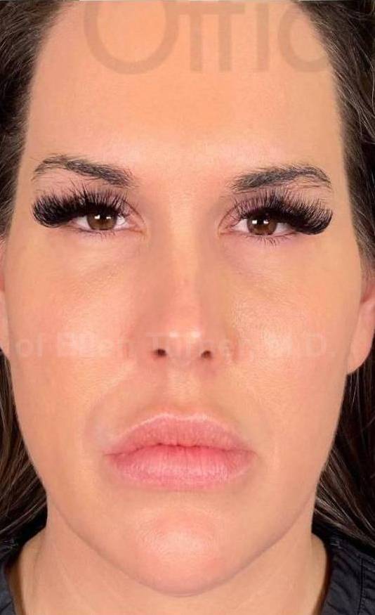 Voluma (4 Syringes) Case 20 After