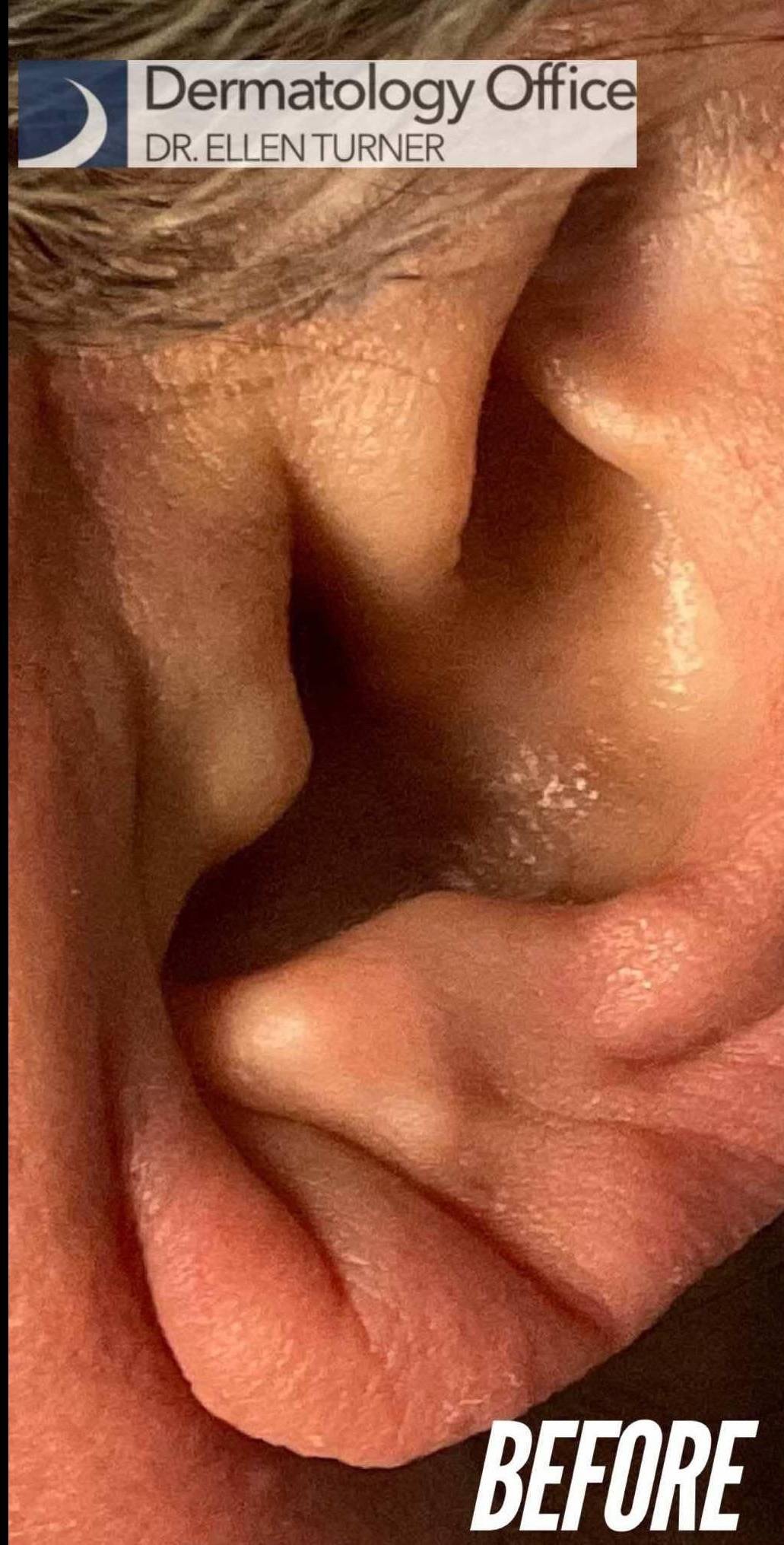 Juvederm (1 Syringe) Case-30 Before