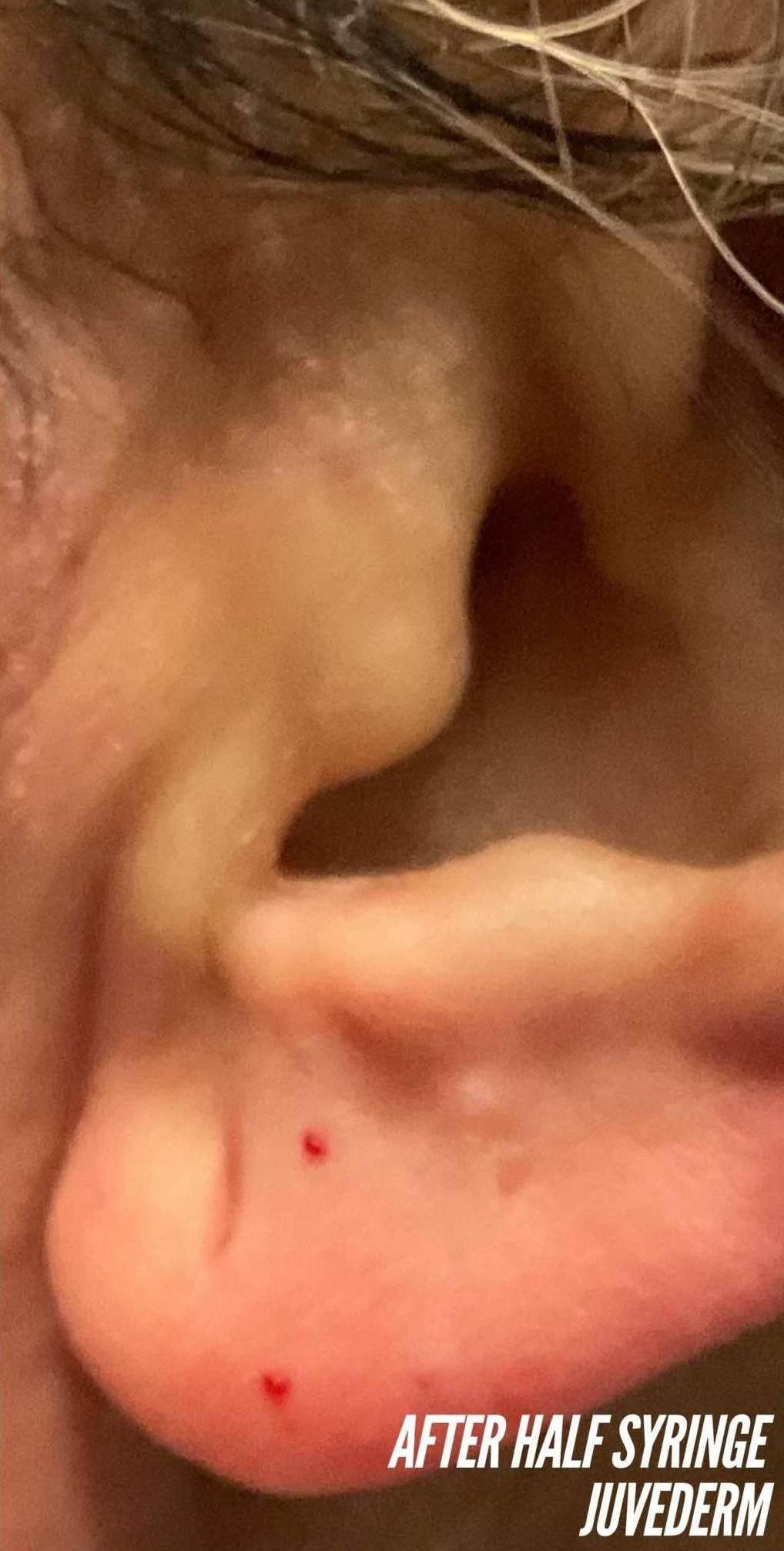 Juvederm (1 Syringe) Case-30 After