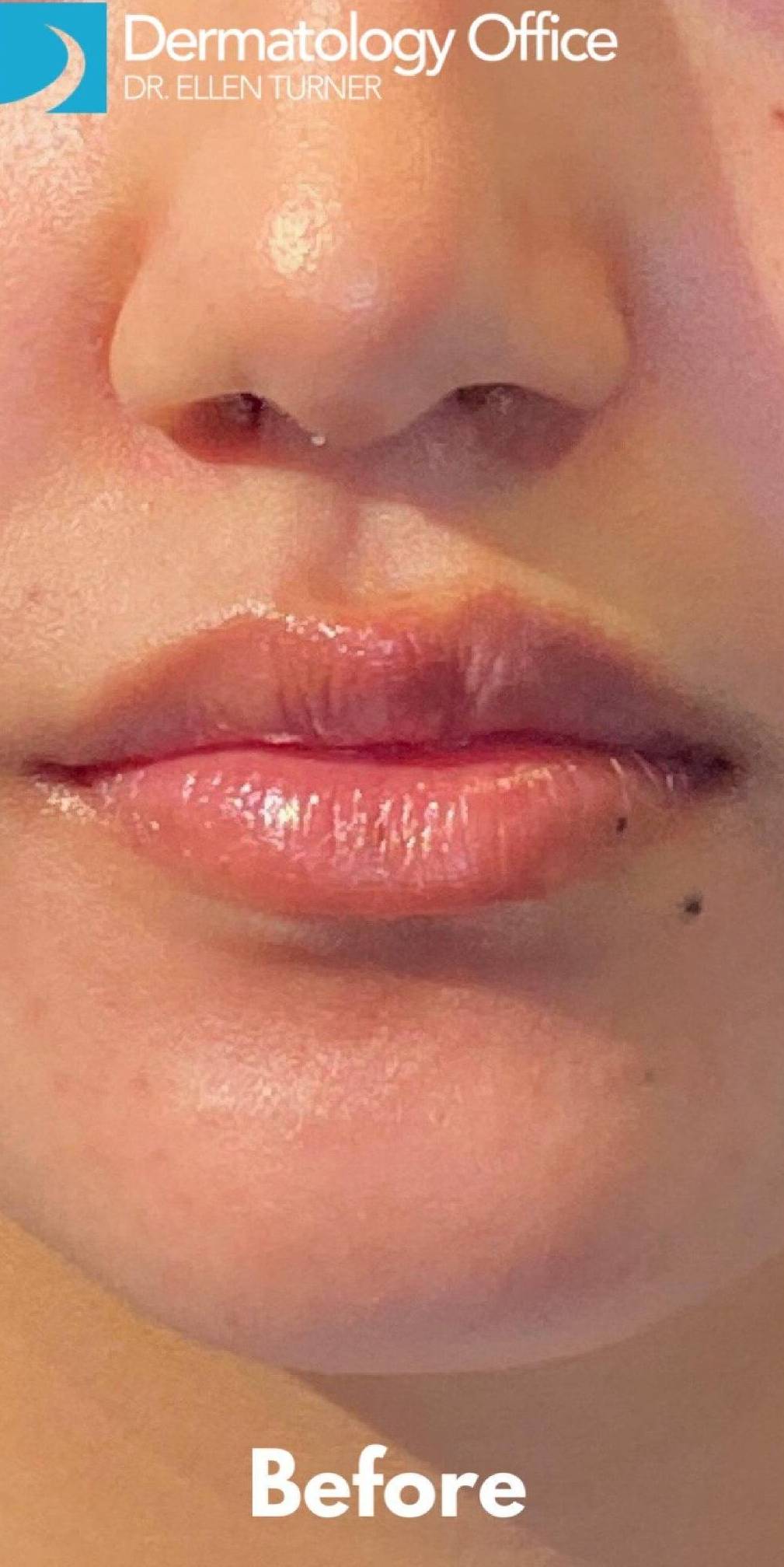 Juvederm (2 Syringes) Case-5 Before