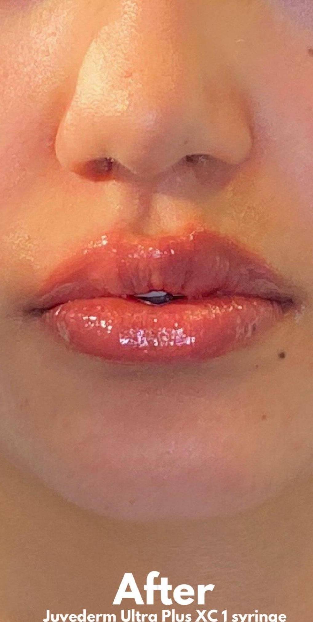 Juvederm (2 Syringes) Case-5 After