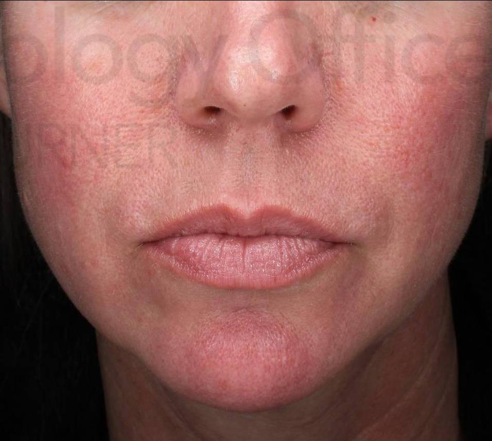 Juvederm (1 Syringe) Case-19 After