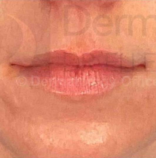 Juvederm (1 Syringe) Case-20 Before