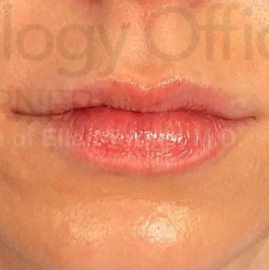 Juvederm (1 Syringe) Case-20 After