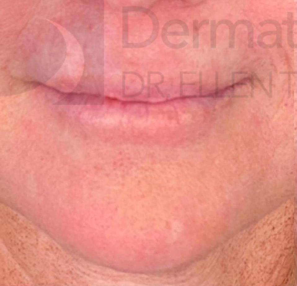 Juvederm (1 Syringe) Case-22 Before