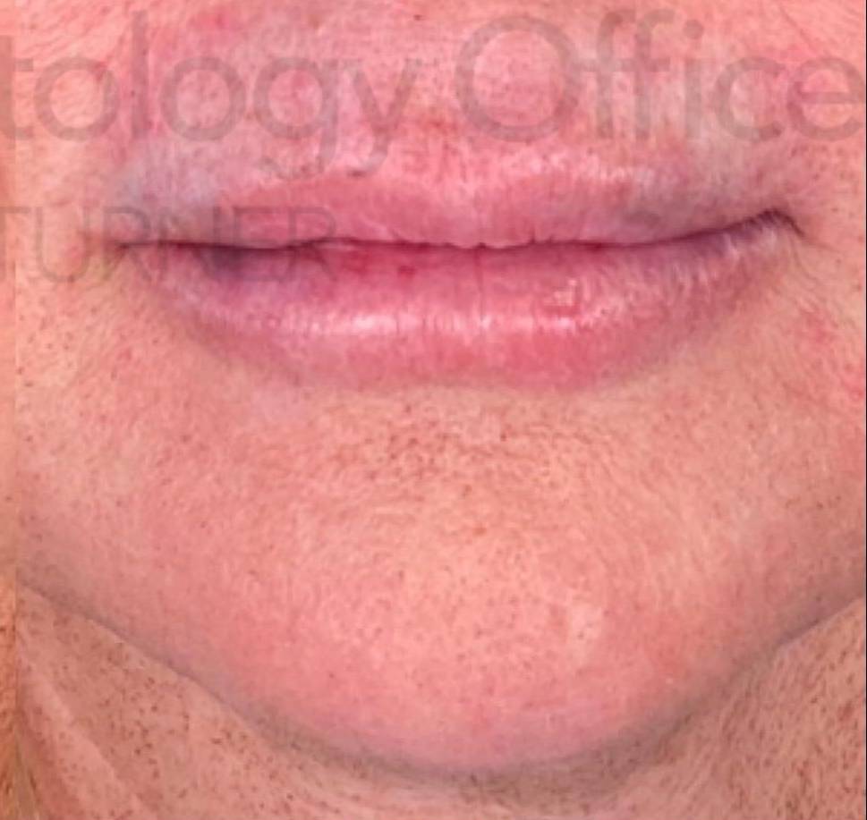 Juvederm (1 Syringe) Case-22 After
