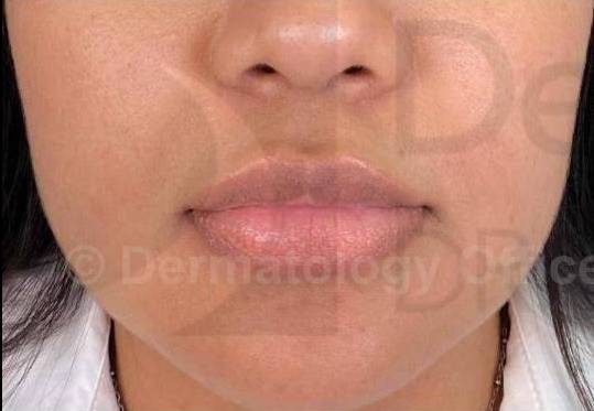 Juvederm (1 Syringe) Case-24 Before