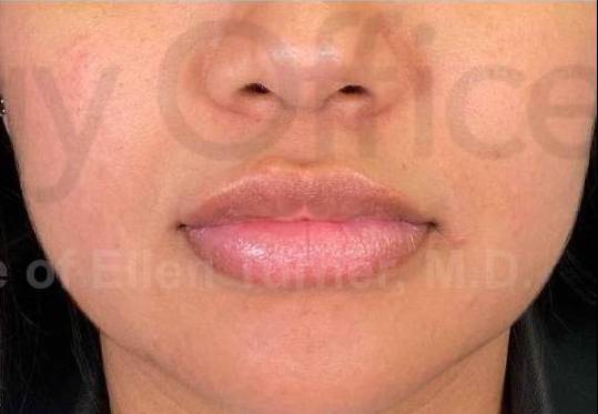 Juvederm (1 Syringe) Case-24 After