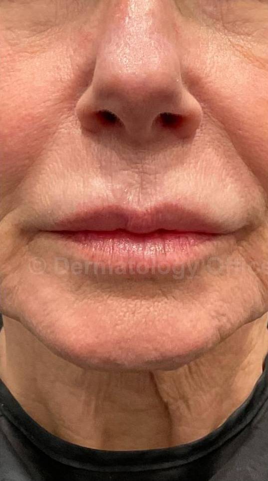 Juvederm (1 Syringe) Case-37 Before