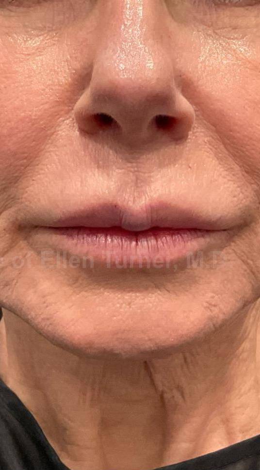 Juvederm (1 Syringe) Case-37 After