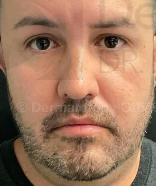 Facial Contouring with Filler (4 Voluma, 1 Kybella) Case 3 Before