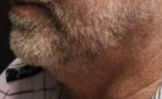 Facial Contouring with Filler (4 Voluma) Case-4 Before