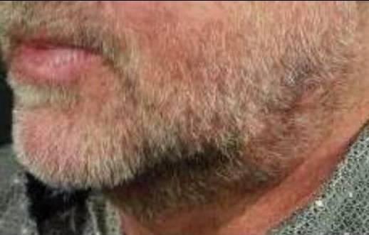 Facial Contouring with Filler (4 Voluma) Case-4 After