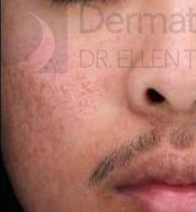 Halo (2 Treatment) Case-5 Before