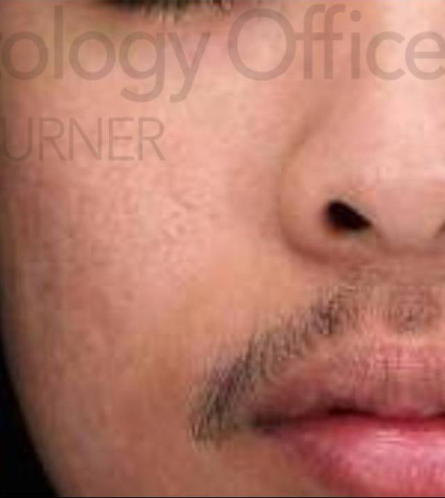 Halo (2 Treatment) Case-5 After