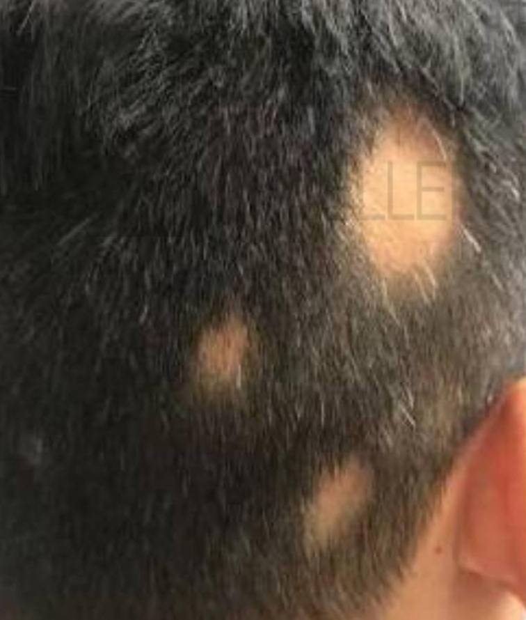 Hair Loss (2 Treatments ExoFlo) Case-6 Before