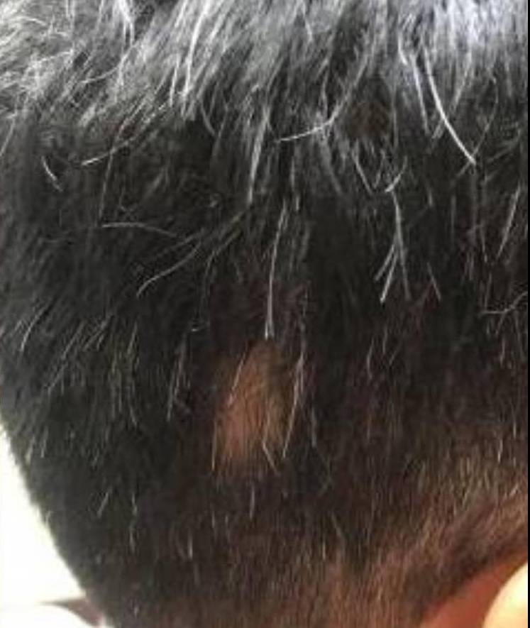 Hair Loss (2 Treatments ExoFlo) Case-6 After