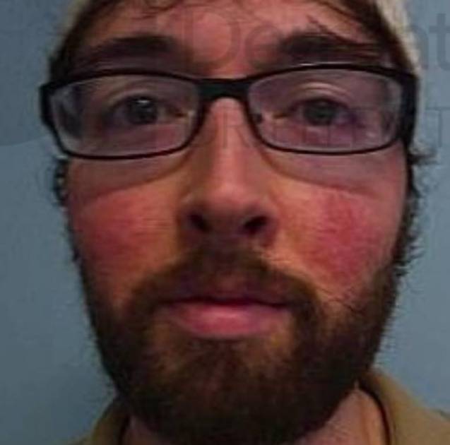 Rosacea (2 Treatment BBL) Case-8 Before