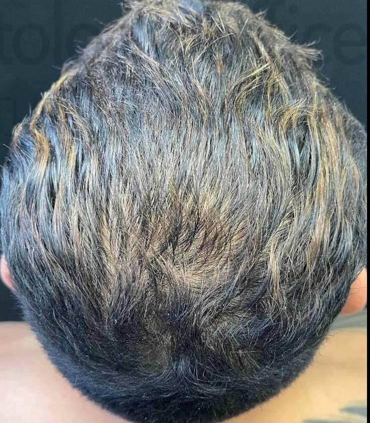 Platelet-Rich Plasma (3 Treatment) Case-10 After