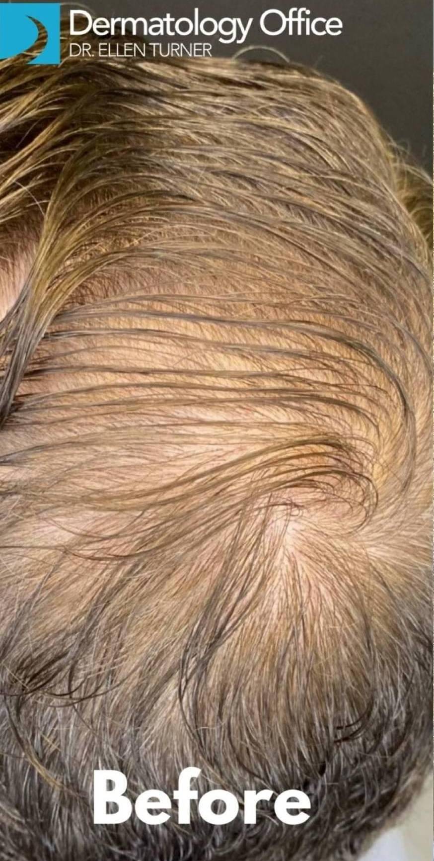 Hair Loss Before and After 11 Before