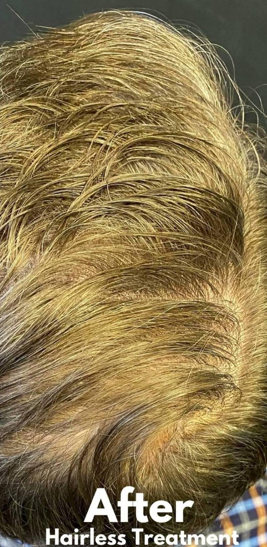 Hair Loss Before and After 11 After