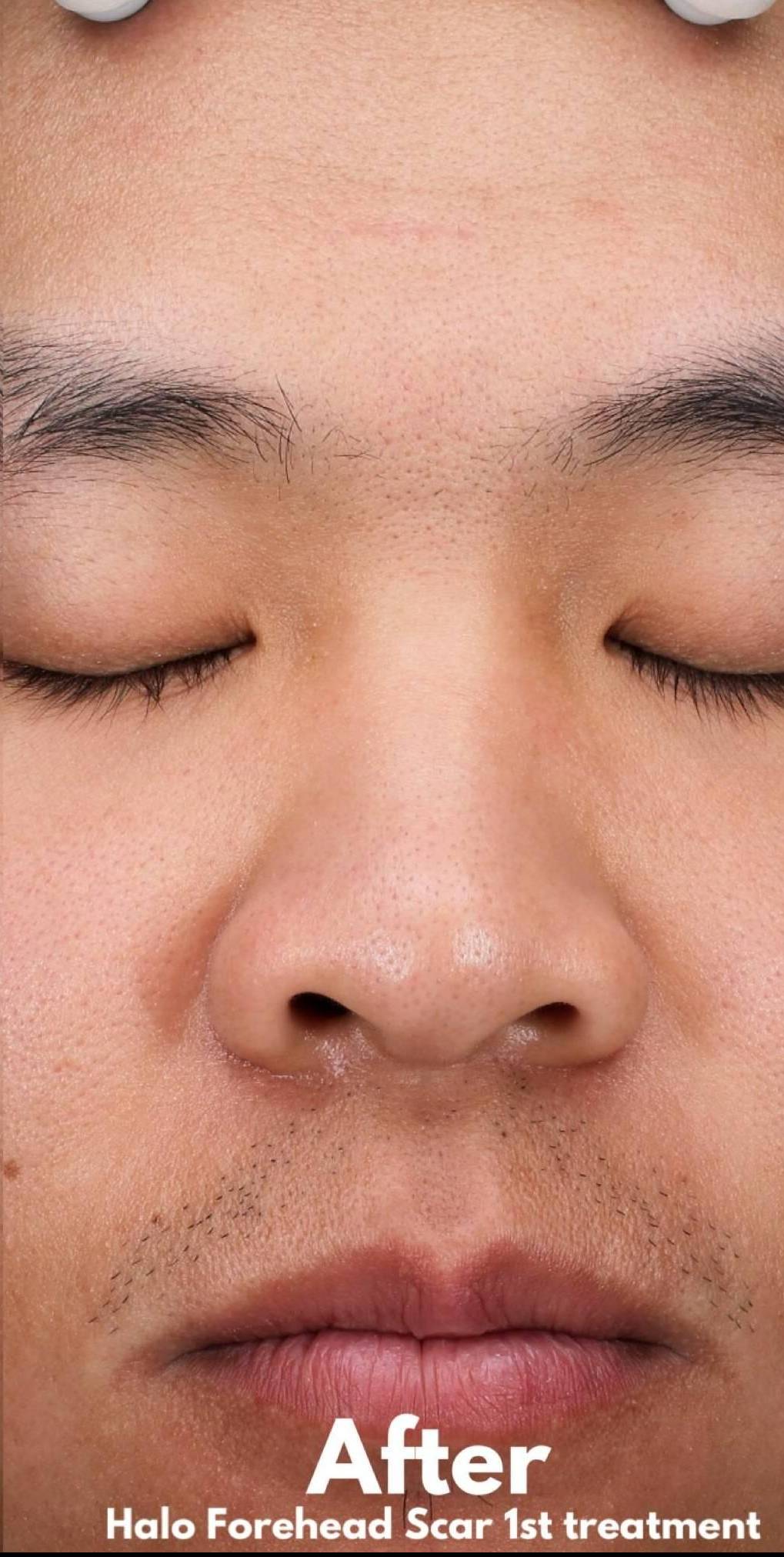 Halo Before and After 26 After