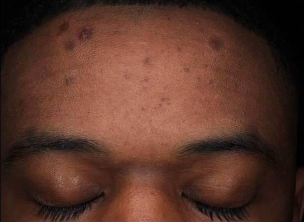 Halo Before and After 27 Before