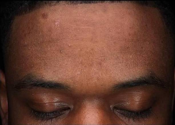 Halo Before and After 27 After